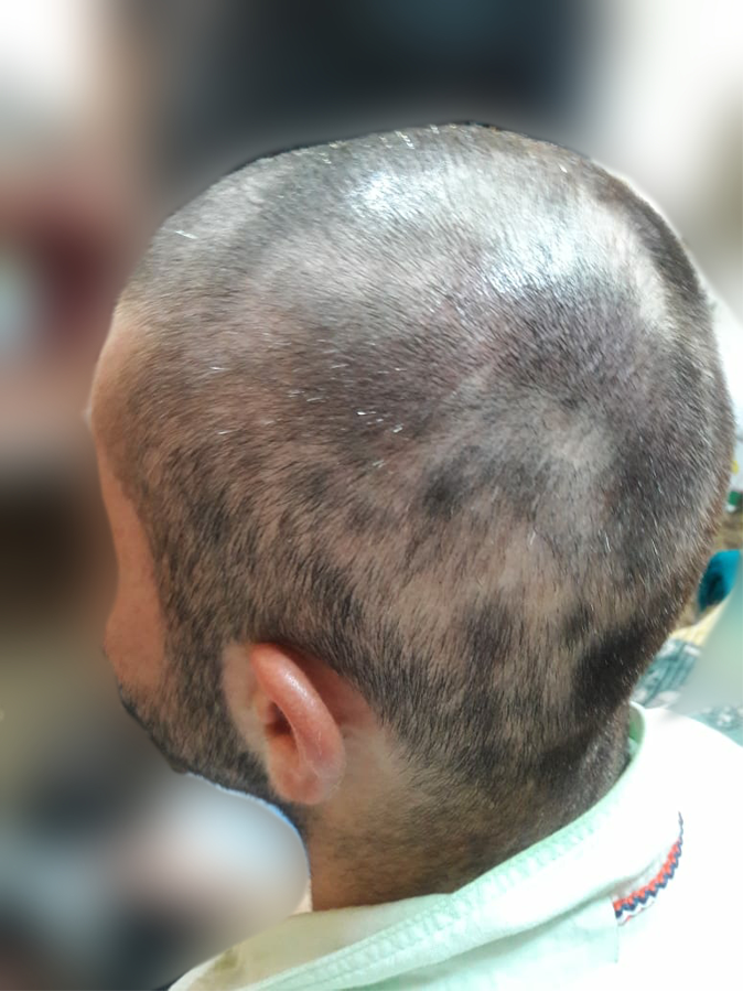 Alopecia after 5 months