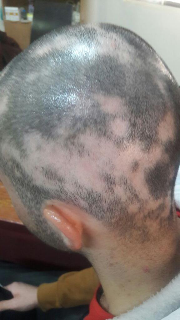 Alopecia before treatment