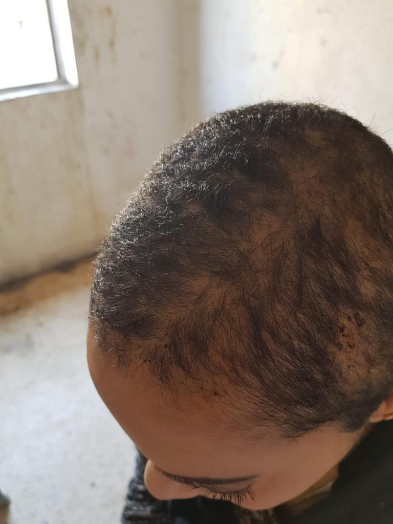 Alopecia after 7 months