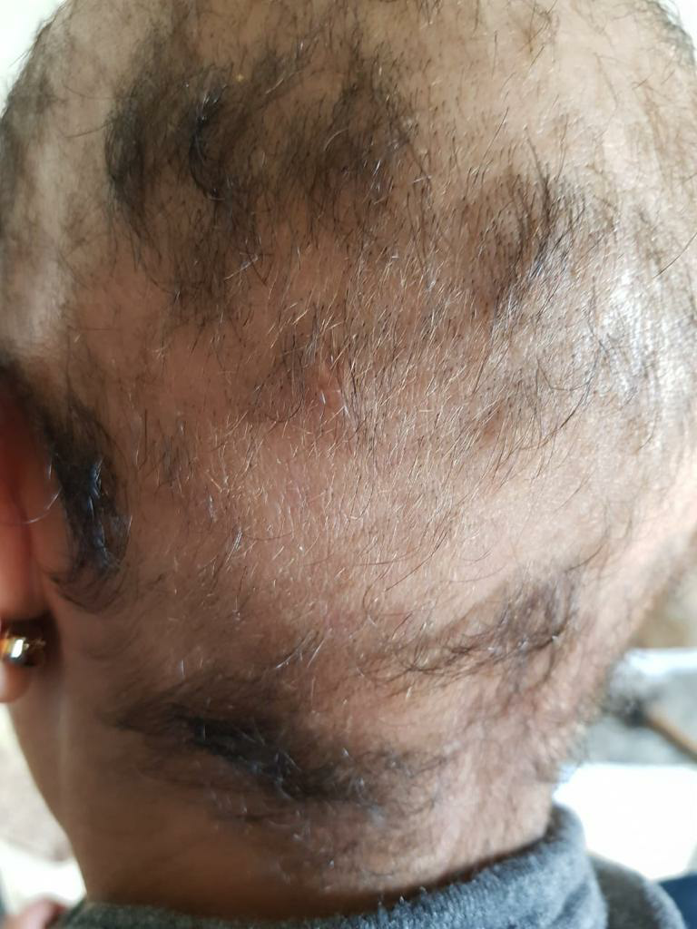Alopecia before treatment