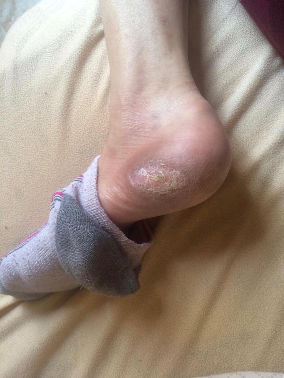 Diabetic foot after treatment