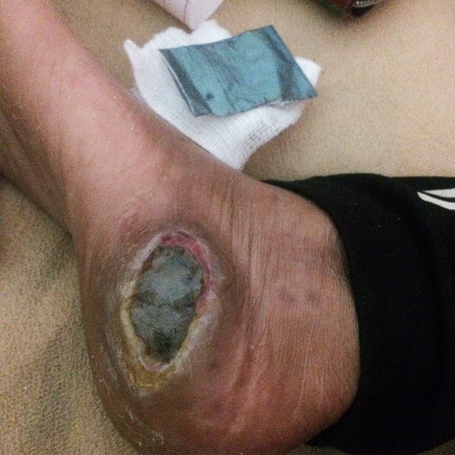 Diabetic foot before