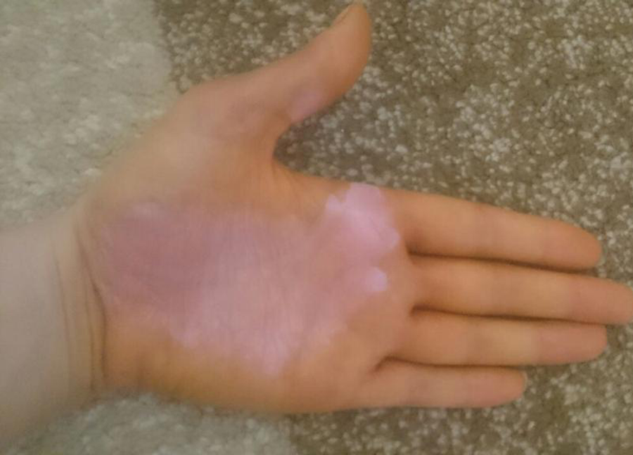 Eczema after 3 months