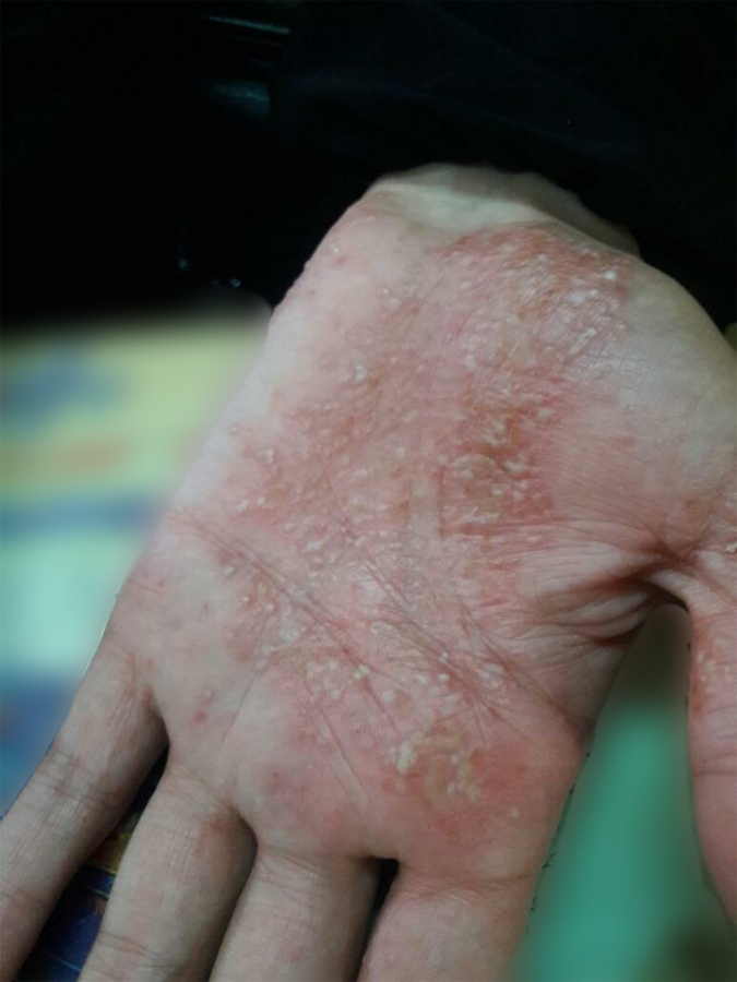 Eczema before treatment