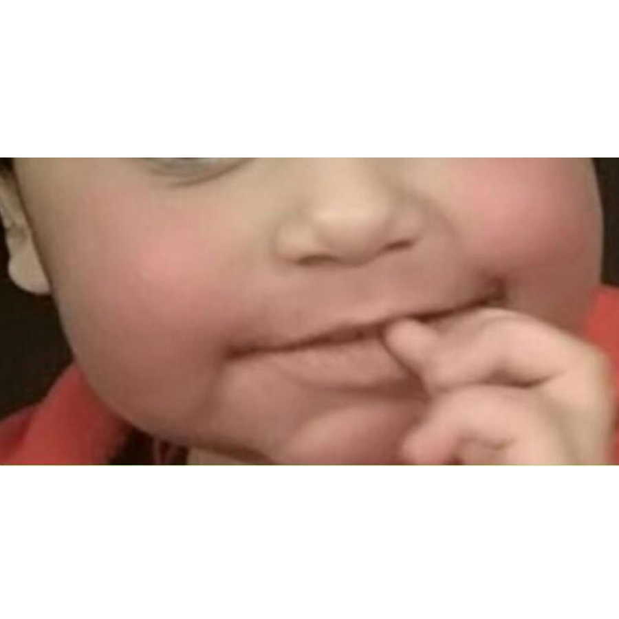 Eczema after treatment
