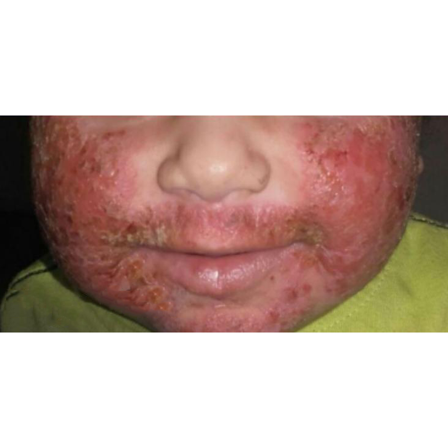 Eczema before treatment