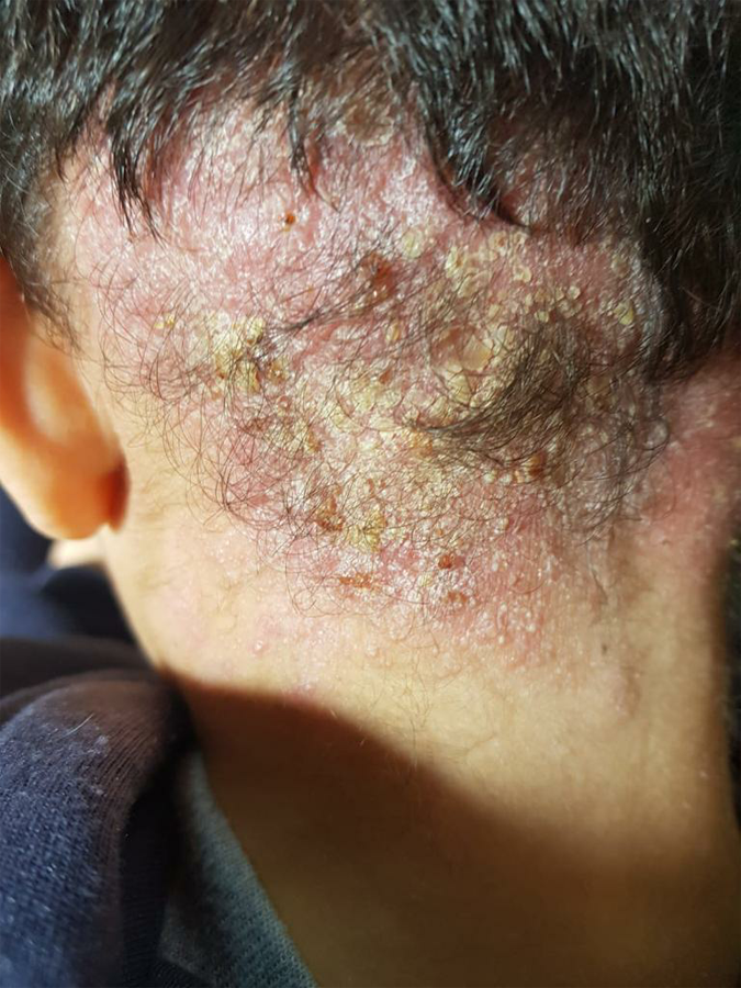 Head ulcers and warts after 4 months