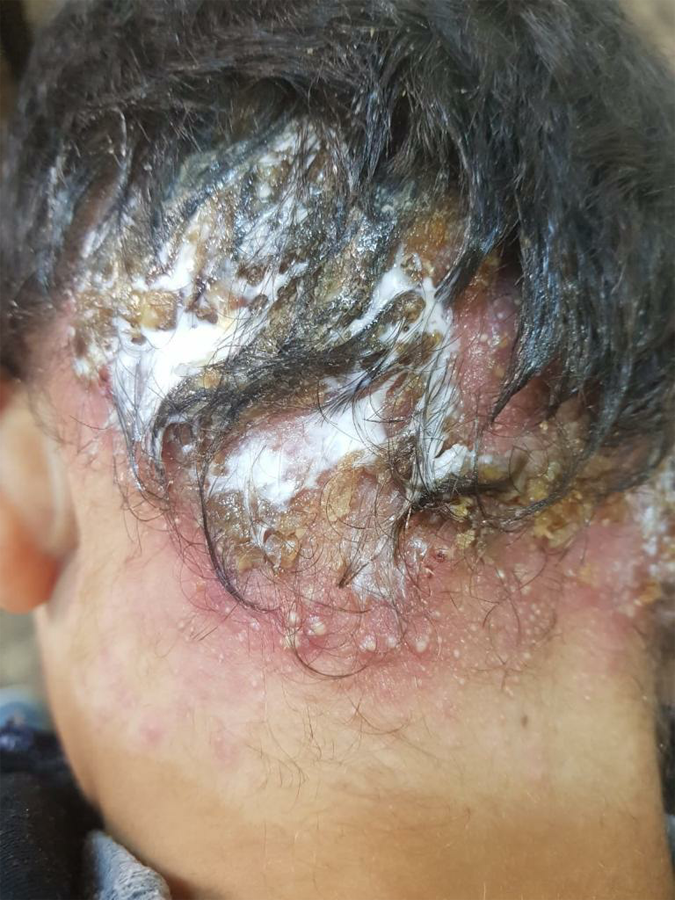 Head ulcers and warts before treatment