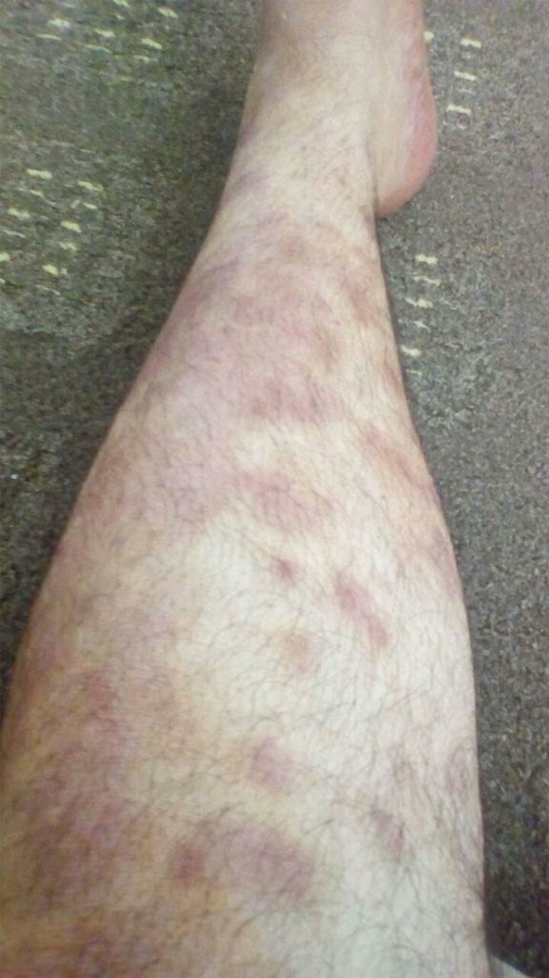 Psoriasis after 1 year