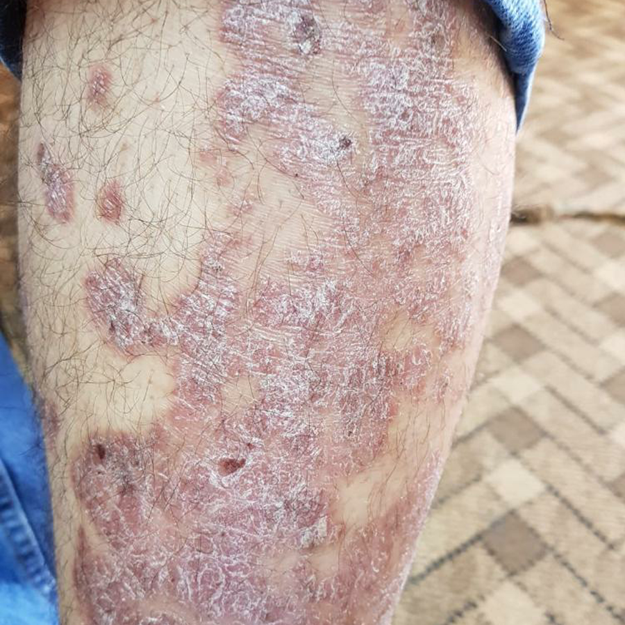 Psoriasis before treatment