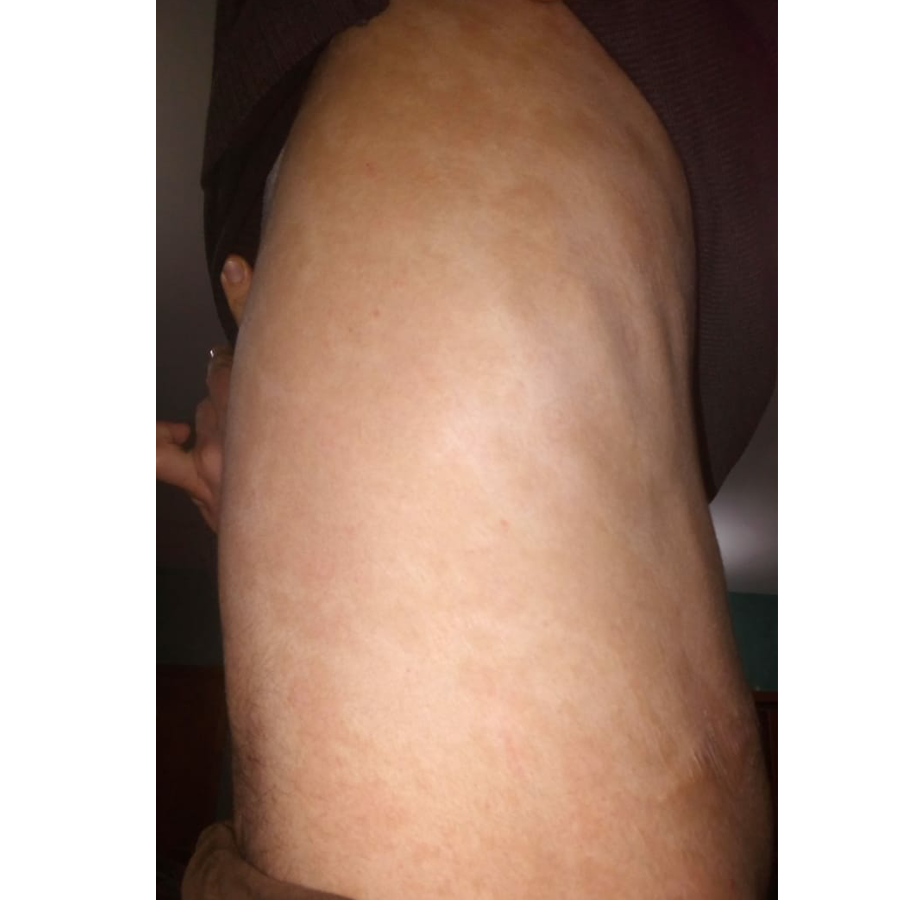 Psoriasis after
