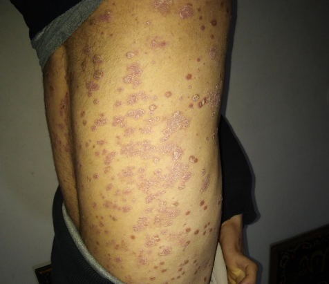 Psoriasis before