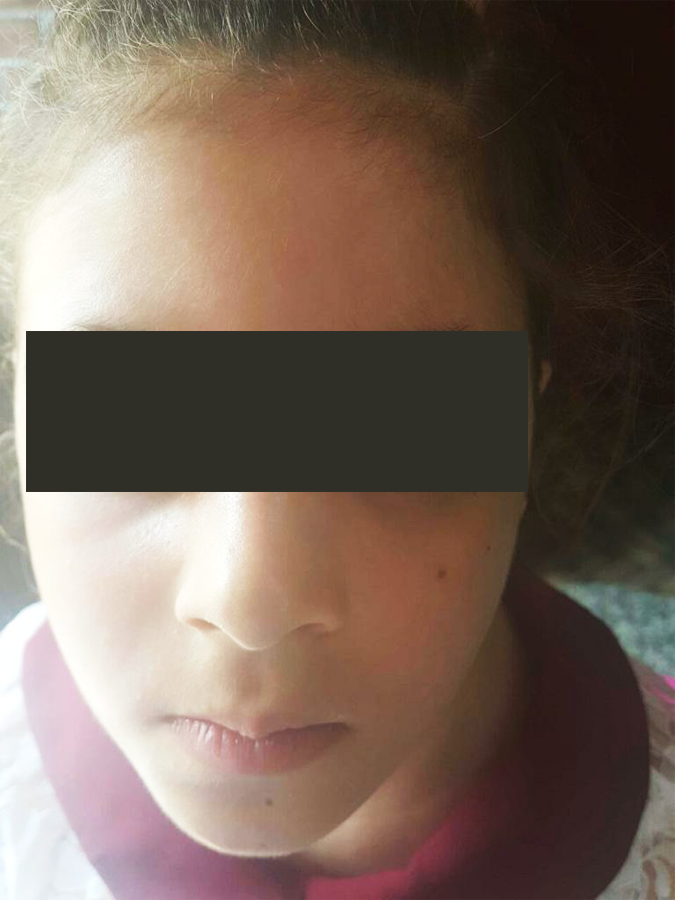 Vitiligo after 1 year
