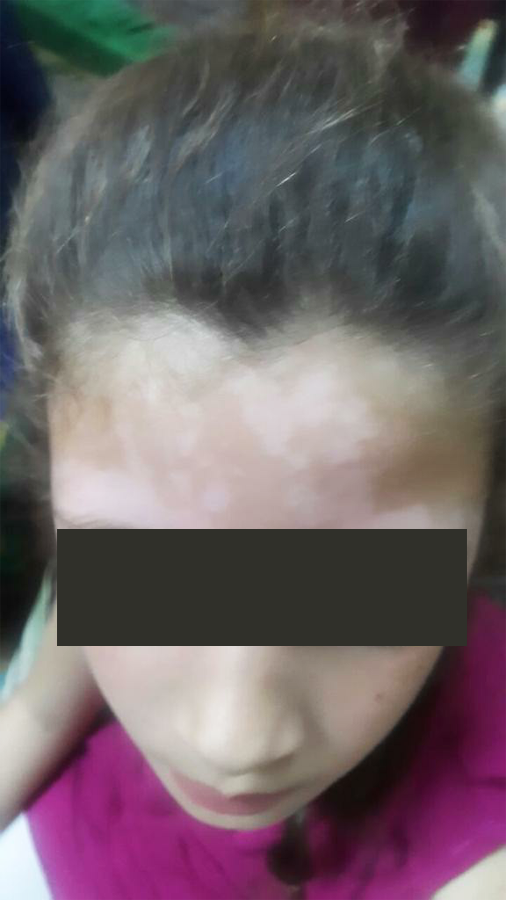 Vitiligo before treatment