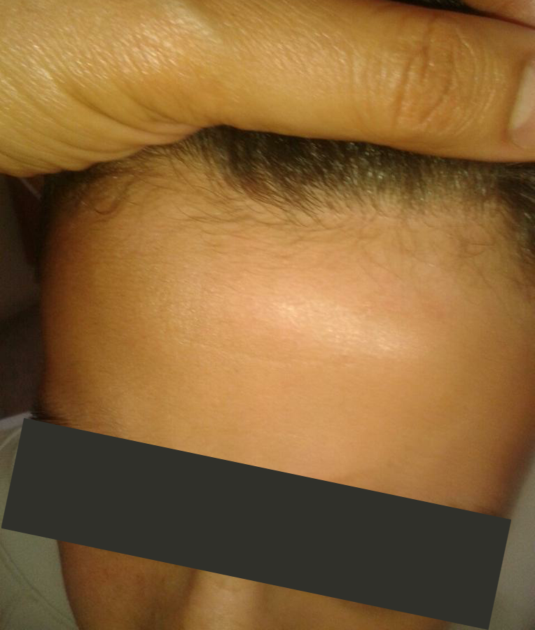 Vitiligo after 1 year
