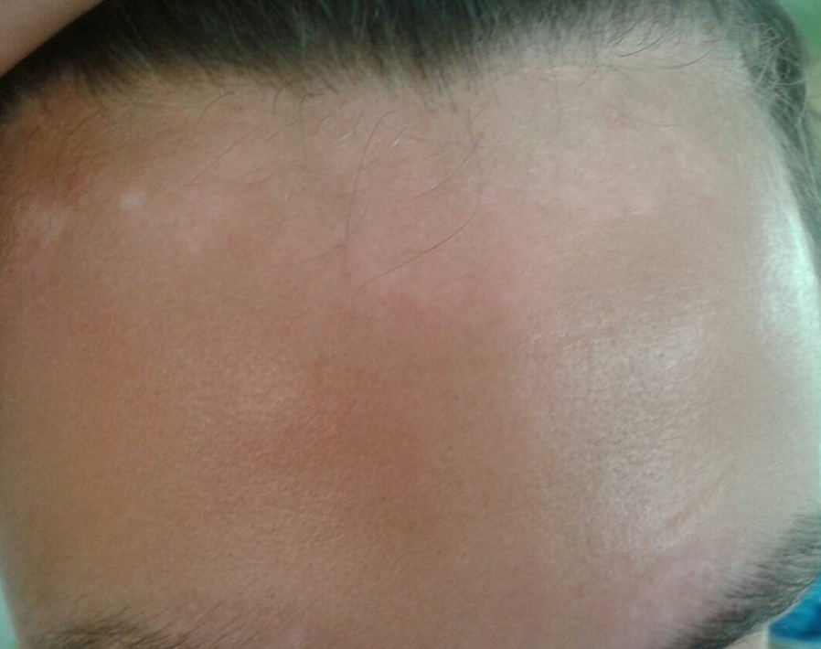 Vitiligo before treatment