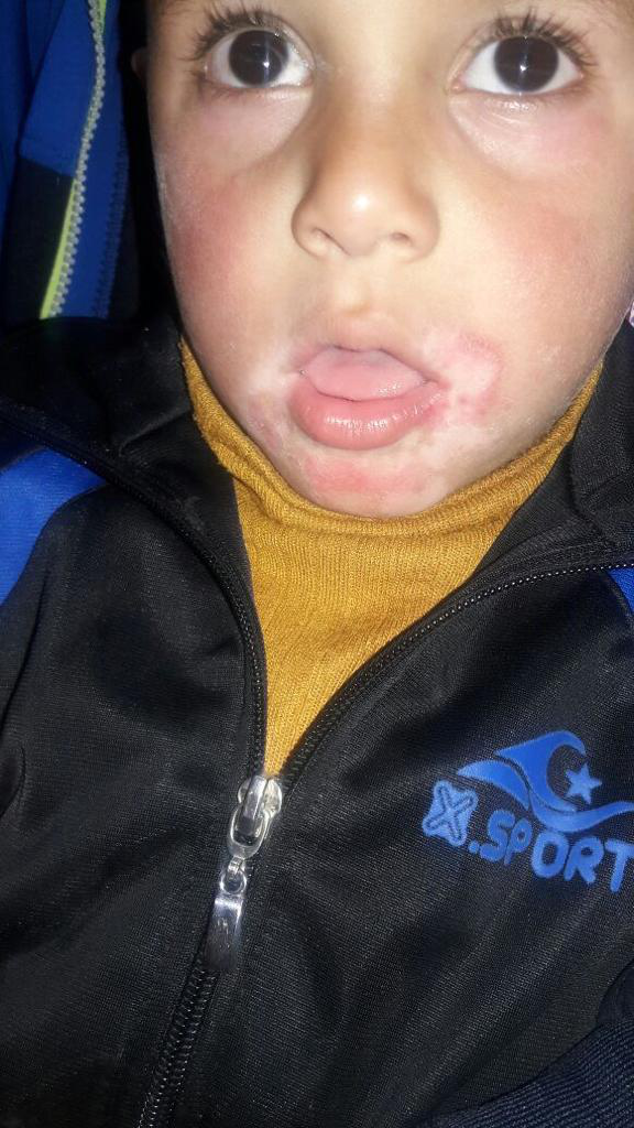 Vitiligo and eczema after 8 months