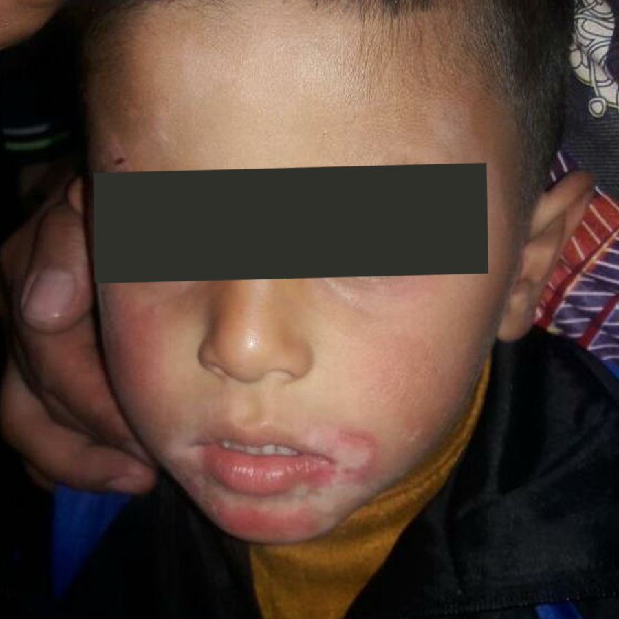 Vitiligo and eczema before treatment